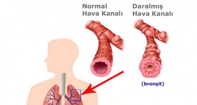 Bronşit nedir belirtileri neler ne iyi gelir