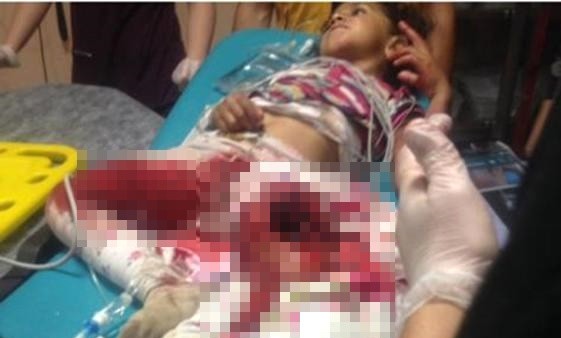 Patoz makinesine kapılan kız çocuğu ağır yaralandı