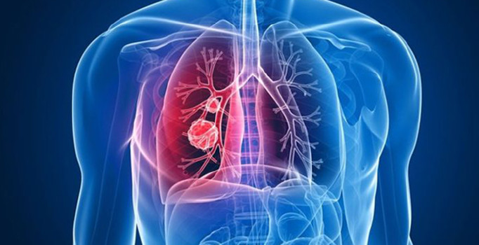 'Her yıl 50 bin kişi akciğer kanseri oluyor'
