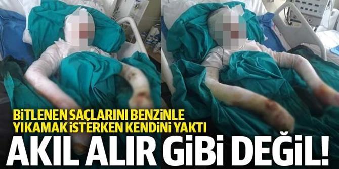 Liseli kız bitlenen saçlarını benzinle yıkamak isterken kendini yaktı