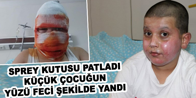 Sprey kutusu patladı, küçük çocuğun yüzü feci şekilde yandı