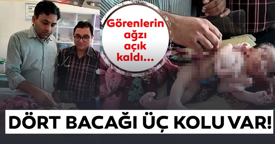 Dört bacaklı, üç kollu kız bebek dünyaya geldi