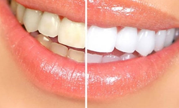 Evde diş beyazlatma yöntemleri! Doğal diş beyazlatma nasıl yapılır?