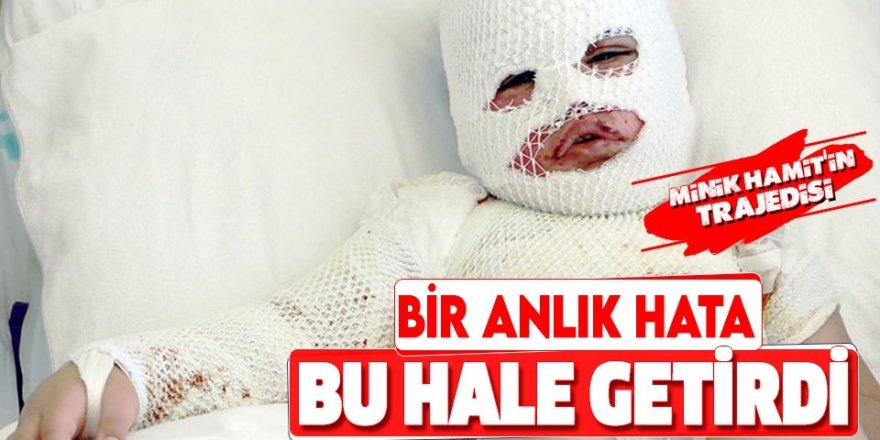 Başından aşağı kaynar su dökülen çocuk Erzurum'da tedaviye alındı