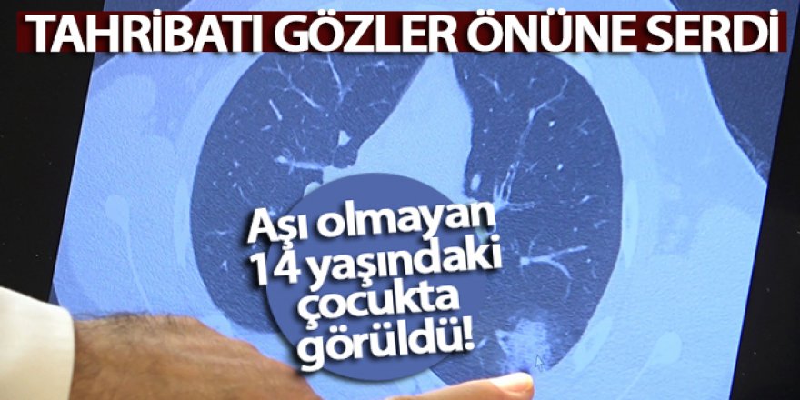 Aşı olmayan 14 yaşındaki çocukta ciddi akciğer tutulumları görüldü