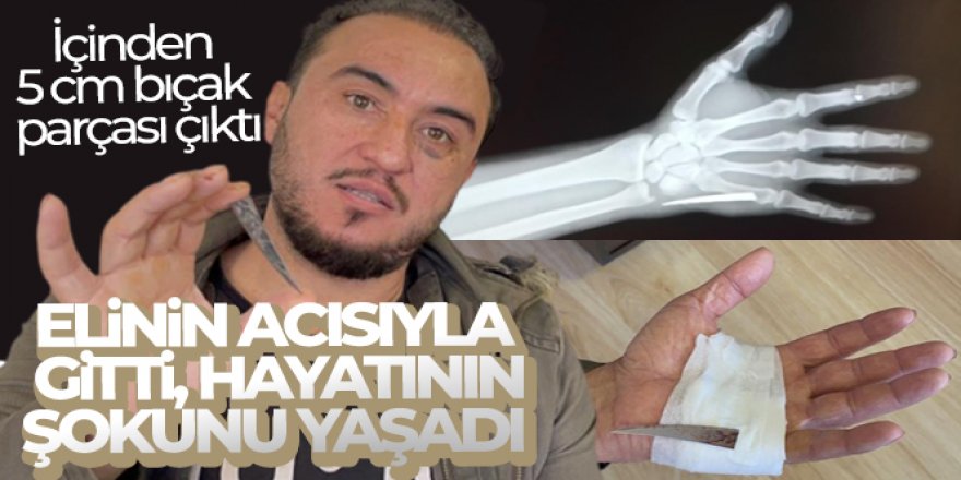 Elinin acısıyla gittiği hastanede çekilen röntgenle hayatının şokunu yaşadı