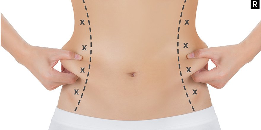 LIPOSUCTION: FAVORİ İNCELME YÖNTEMİ