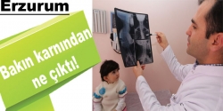 Küçük çocuğun midesinden bakın ne çıktı