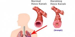Bronşit nedir belirtileri neler ne iyi gelir