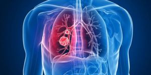 'Her yıl 50 bin kişi akciğer kanseri oluyor'