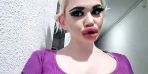 Barbie'ye benzemek isteyen genç kız dudağına 20'den fazla dolgu yaptırdı