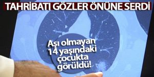 Aşı olmayan 14 yaşındaki çocukta ciddi akciğer tutulumları görüldü