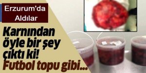 Erzurum'da Karnından futbol topu büyüklüğünde tümör çıktı