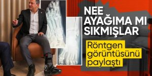 Özel ayak röntgen filmlerini paylaştı